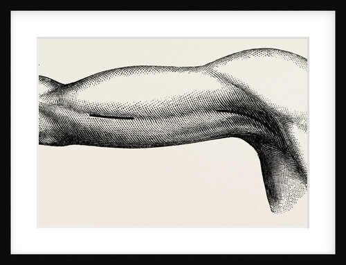 Ligature of the brachial about the middle of the arm by Anonymous