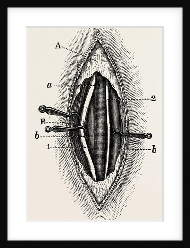 Ligature of the right finger by Anonymous