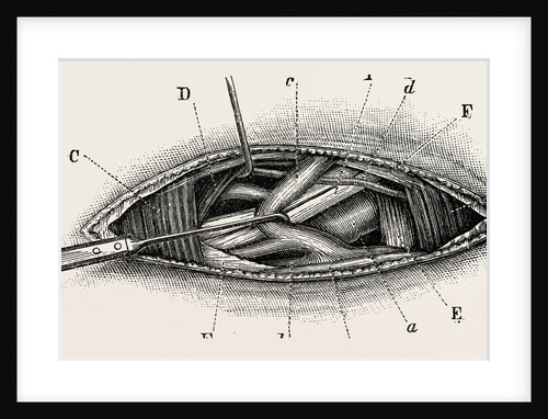 Ligature of the right subclavian ernird part by Anonymous