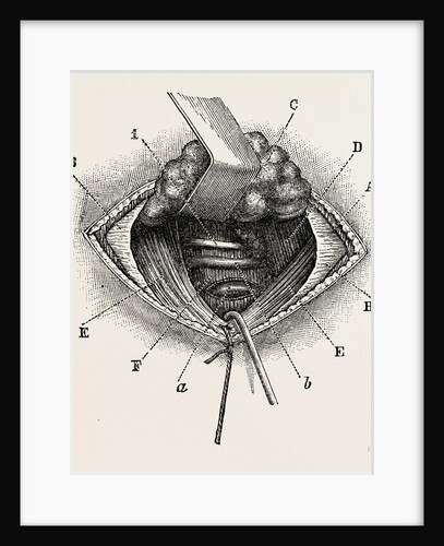 Ligature of right lingual artery by Anonymous