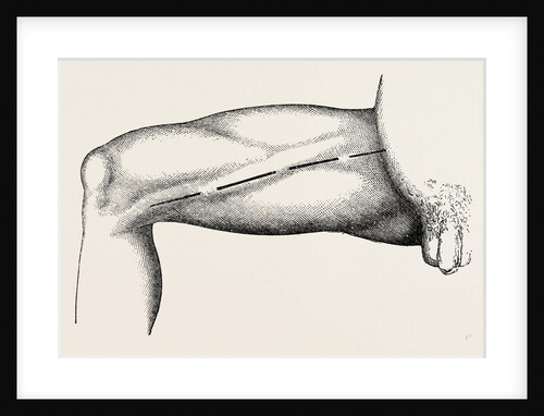 Ligature of the right common femoral at the base of scarpa's by Anonymous
