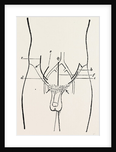 Ligature of external iliac by Anonymous