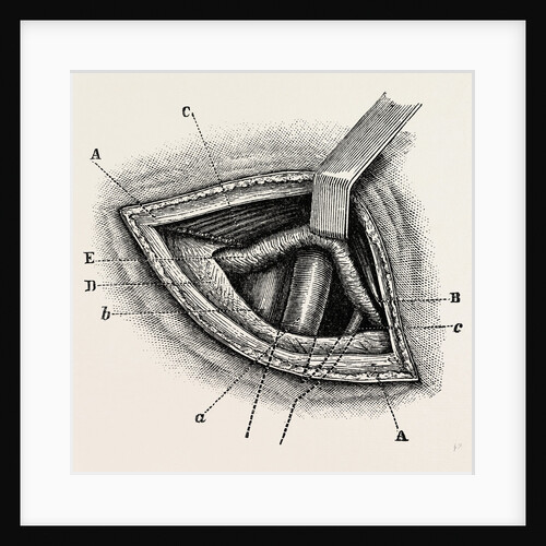 Ligature of right external iliac artery by Anonymous