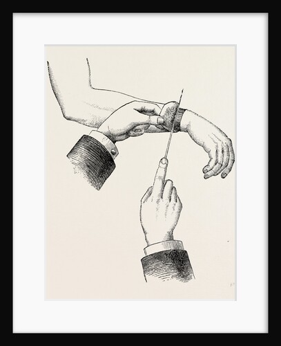 Circular amputation de la manchette by Anonymous