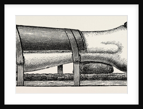 Supporting splint adjusted to the leg by Anonymous