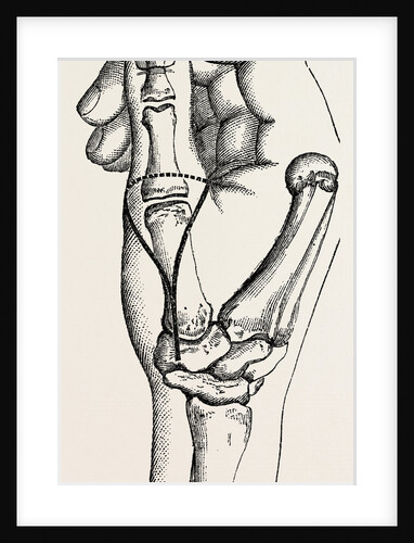 Disarticulation by Anonymous