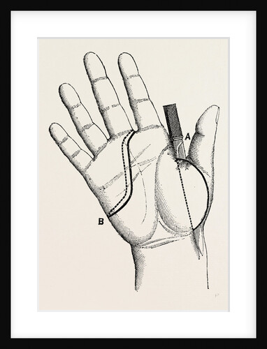 Disartieulation of the thumb by Anonymous