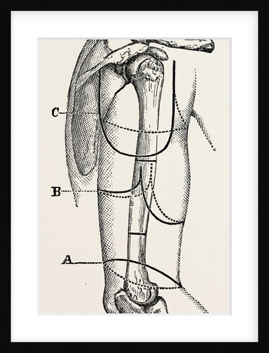 Circular (inclined) amputation by Anonymous