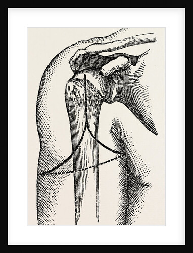 Disarticulation by Anonymous