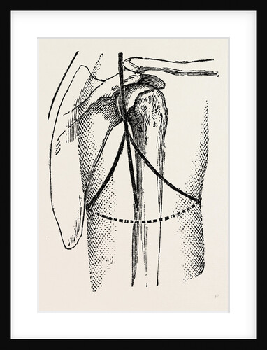 Disaetictjlation at the posterior part of the oval by Anonymous