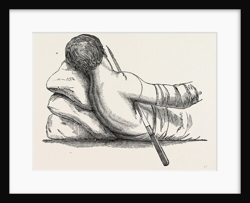 Amputation at the shoulder-joint by transfixion by Anonymous