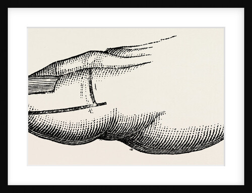 Disarticulation by Anonymous