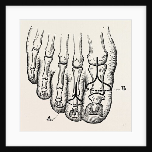Disarticulation by Anonymous