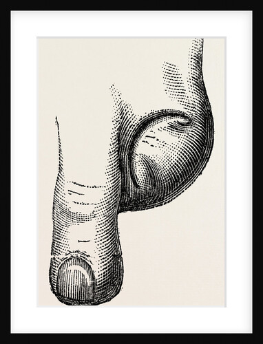 Disarticulation by Anonymous