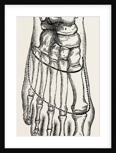 Lisfranc's amputation by Anonymous