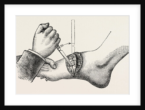 The coup de maitre in lisfrancis amputation by Anonymous