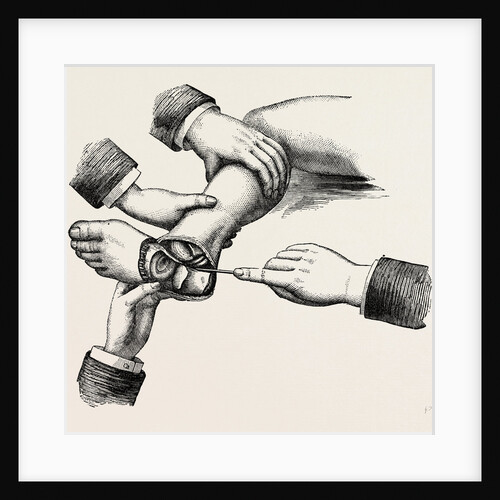 Subastragaloid amputation of the left foot by Anonymous
