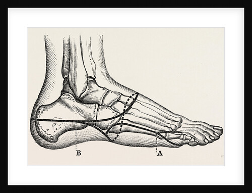 Disarticulation of the little toe by Anonymous