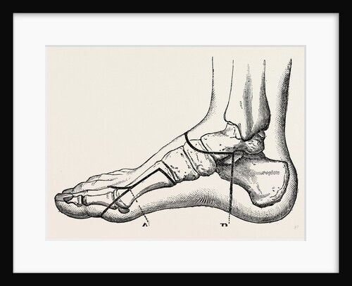 Disarticulation of the great toe by Anonymous