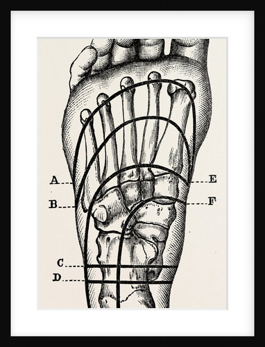 Plantar incisions by Anonymous