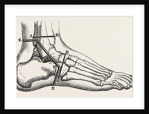 Osteo-plastic resection of the foot by Anonymous