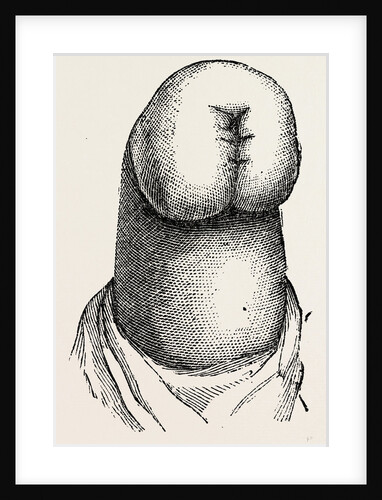 The stump by Anonymous