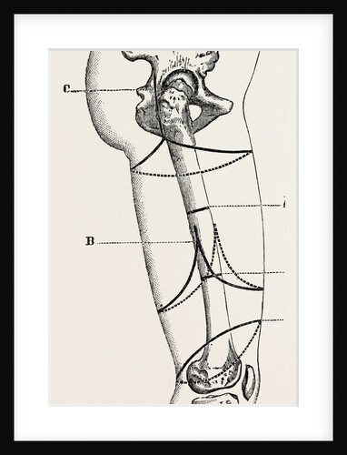 Circular amputation of thigh by Anonymous