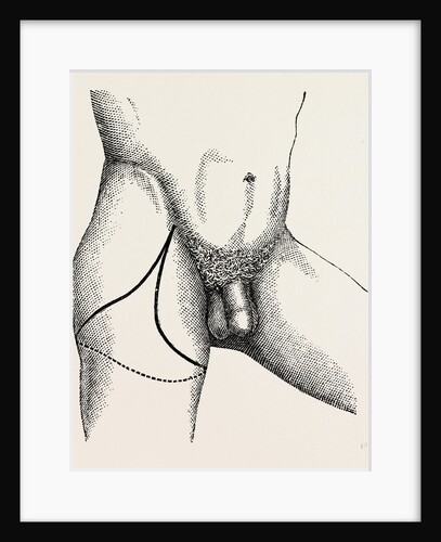 Disarticulation by Anonymous