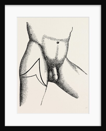 Lisfrancs disarticulation by Anonymous