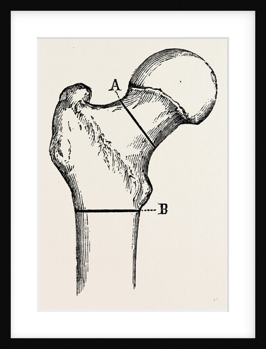 Osteotomy by Anonymous