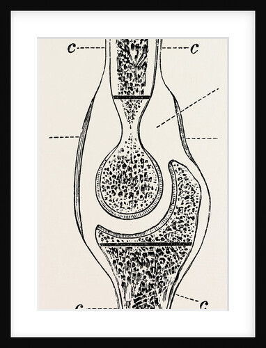 Diagrams to illustrate the sub-periosteal method of resection by Anonymous