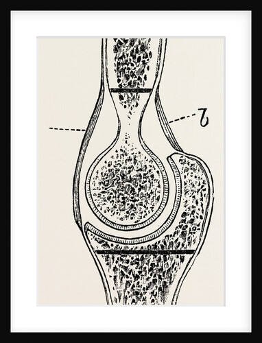Diagrams to illustrate the sub-periosteal method of resection by Anonymous