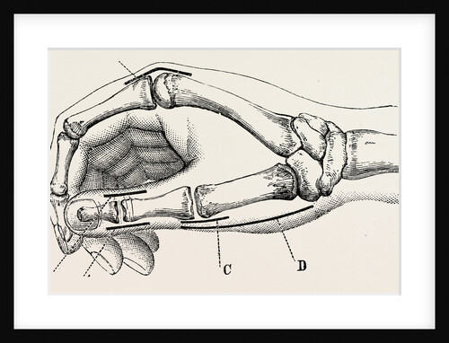 Excision of metacarpo-phalangeal joint by Anonymous