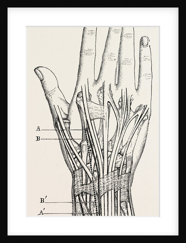 Excision of the wrist by Anonymous