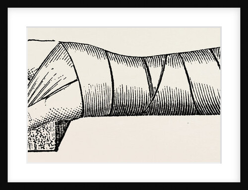 Lister's splint for excision by Anonymous