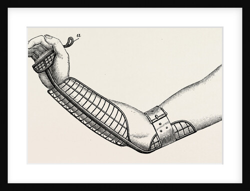 Ollieris wire splint for excision of the wrist by Anonymous