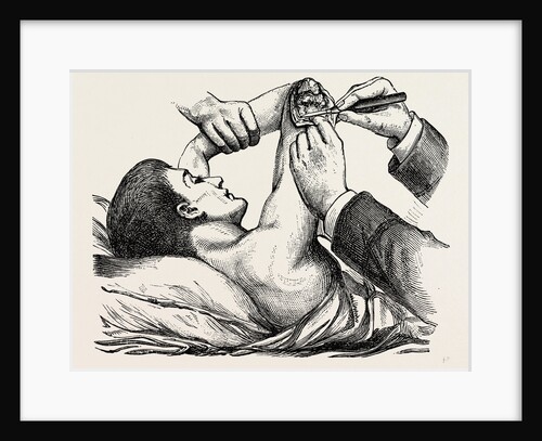 Excision of the elbow, the clearing of the humerus by Anonymous