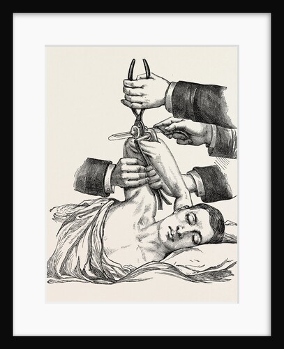 Excision of the elbow, sawing of the humerus by Anonymous