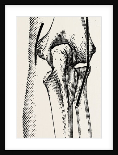 Excision the elbow is now extended by Anonymous