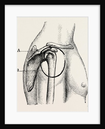 Excision of the shoulder by Anonymous