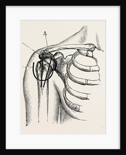 Excision of the shoulder by Anonymous