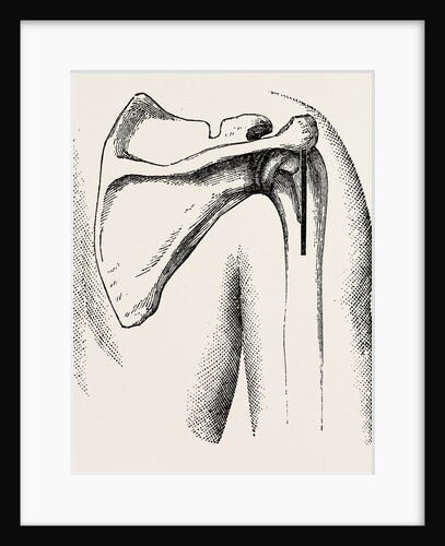 Excision of shoulder by Anonymous