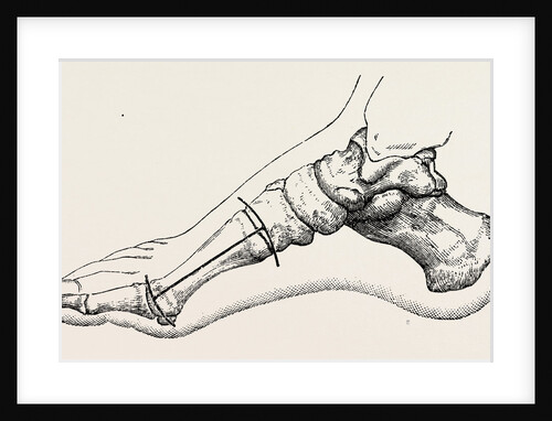 Excision of first metatarsal bone by Anonymous
