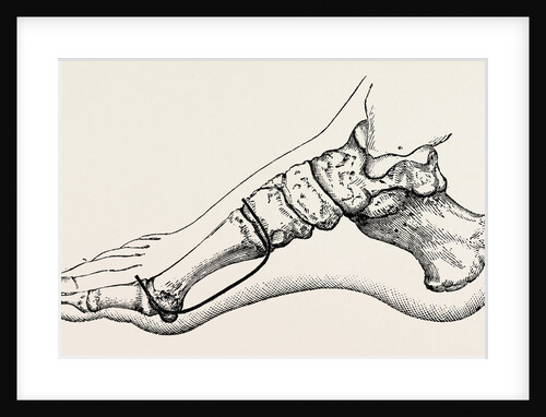 Eicision of first metatarsal bone, flap by Anonymous
