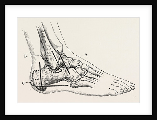 Excision of astragalus, outer incision by Anonymous