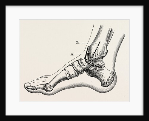 Excision of astragalus, inner incision by Anonymous
