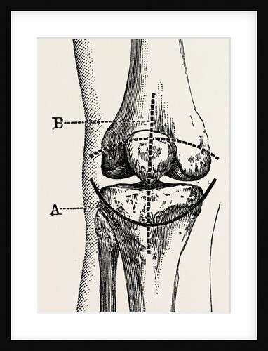 Excision of the operation the limb by Anonymous