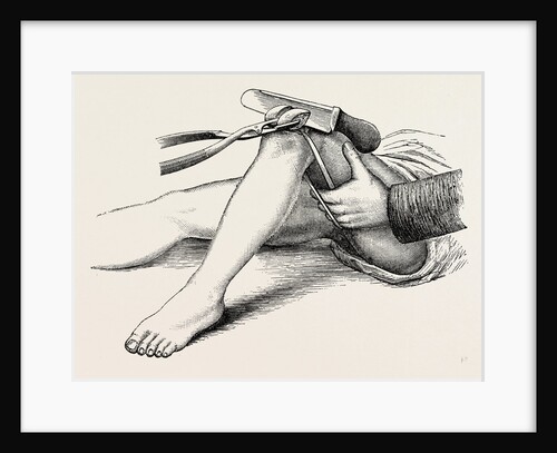 Excision of the knee, the sawing of the lower end by Anonymous