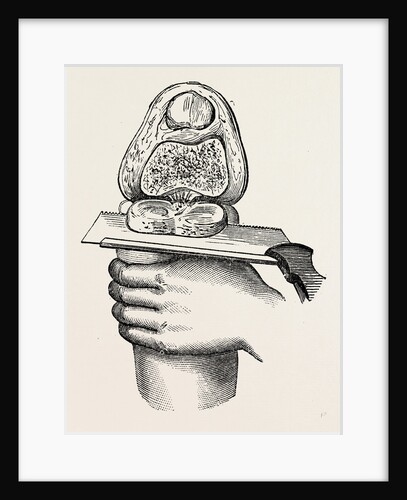 Excision of the knee by Anonymous