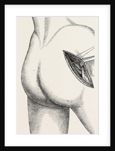 Excision of the hip by an external incision by Anonymous